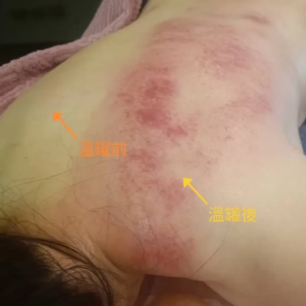 冠緻時尚美學-新北林口、艾草溫罐、暖宮按摩、經絡按摩、孕婦按摩、肌膚管理、熱蠟除毛-2401艾草溫罐-6
